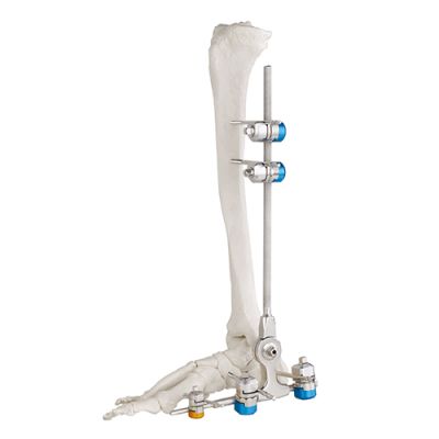 Ankle Joint External Fixator