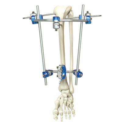 Proximal Tibia External Fixator