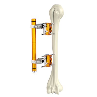 Humeral Shaft External Fixator