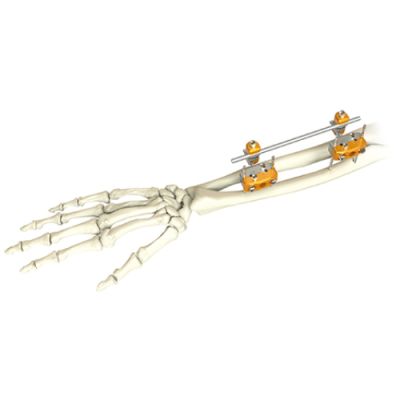 Forearm External Fixator