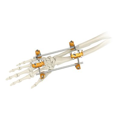 Ulna & Radius External Fixator