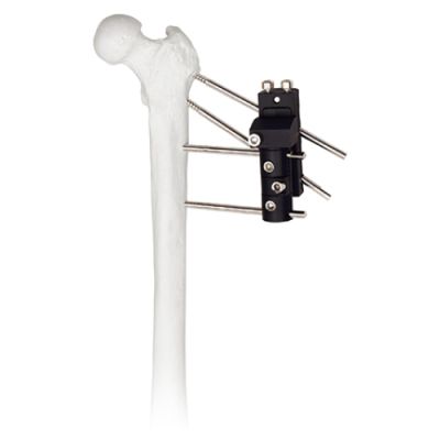 Hip Joint Traction External Fixator